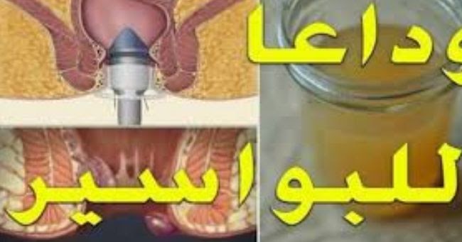 أفضل مرهم للبواسير في السعودية، موسوعة المخرج