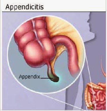 Understanding about Appendicitis