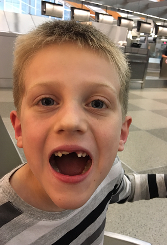 Front teeth missing two Congenitally Missing