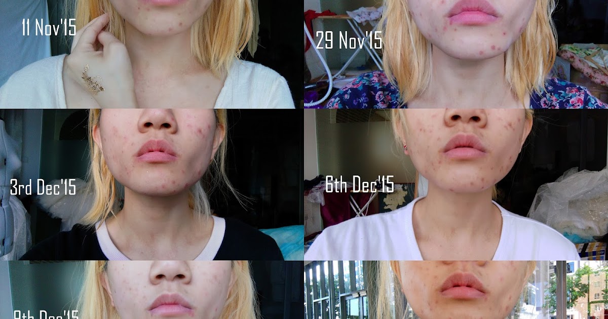 hada labo for acne skin