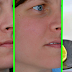 Remove Your Scars With These Simple Yet Effective Remedies