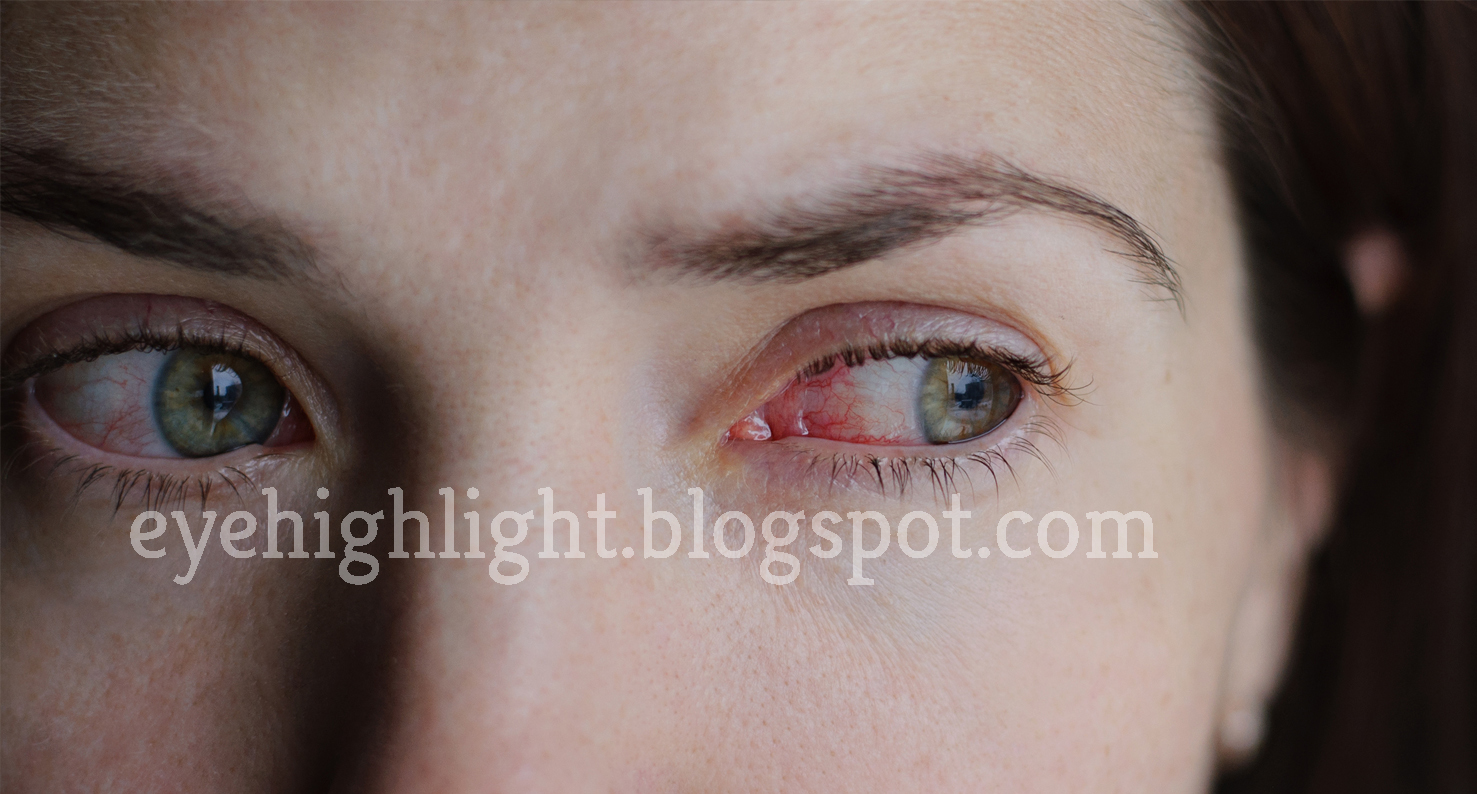 Oral Antibiotics For Common Eye Infections From Contacts With The Name
