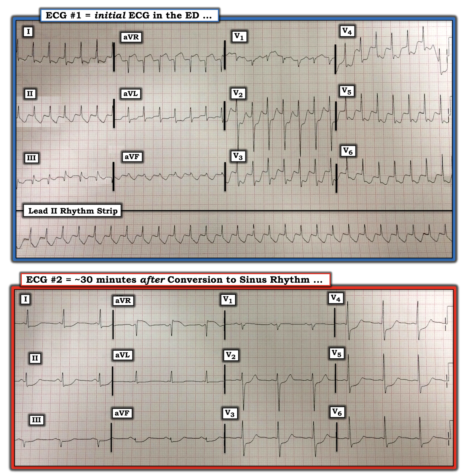 Dr. Smith's ECG Blog Does ST Elevation in lead aVR indicate acute coronary occlusion?