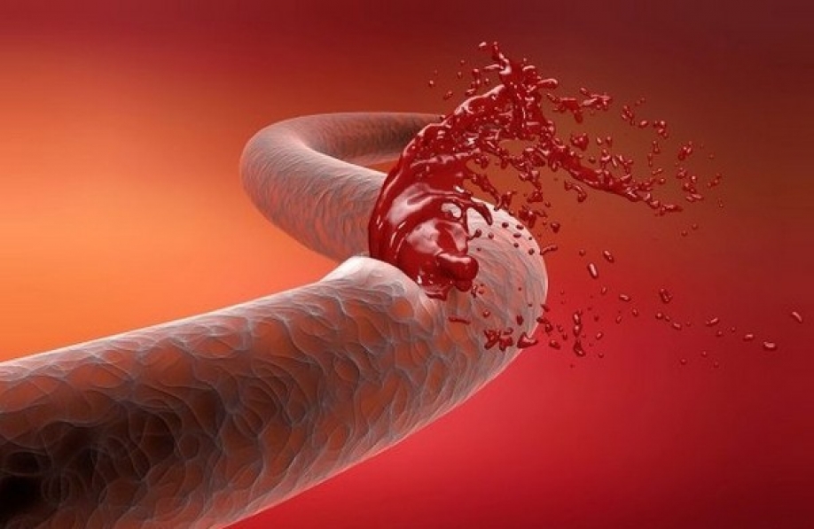 Definition of major bleeding in surgical studies - Anesthesiology and