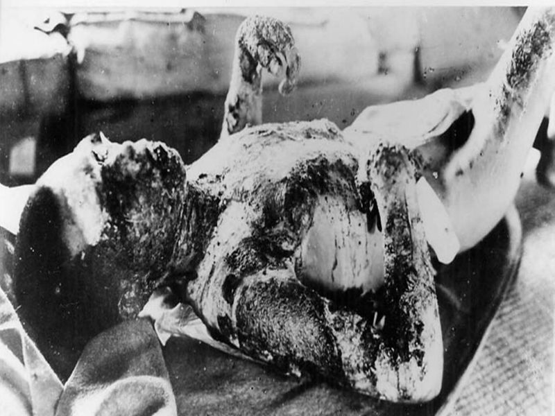 Fotos das vitimas da bomba atomica 97 Fotos das vitimas da bomba atomica 1