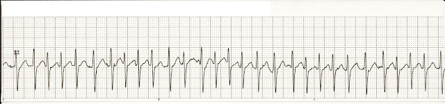 Identify the appropriate electrical intervention for the following EKG ...