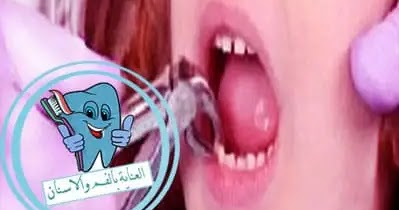 بعد خلع السن كيفية وقف الدم وأهم الاحتياطات بعد خلع السن