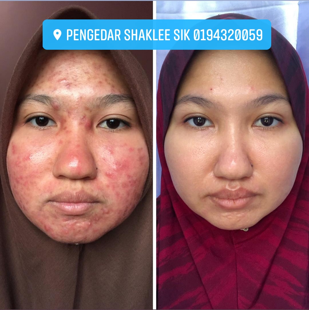 Kulit Muka Breakout Alergik Makan Seafood Akhirnya Dah Pulih  Umi Nazrah