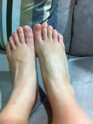 Swollen And Inflammed Feet 69