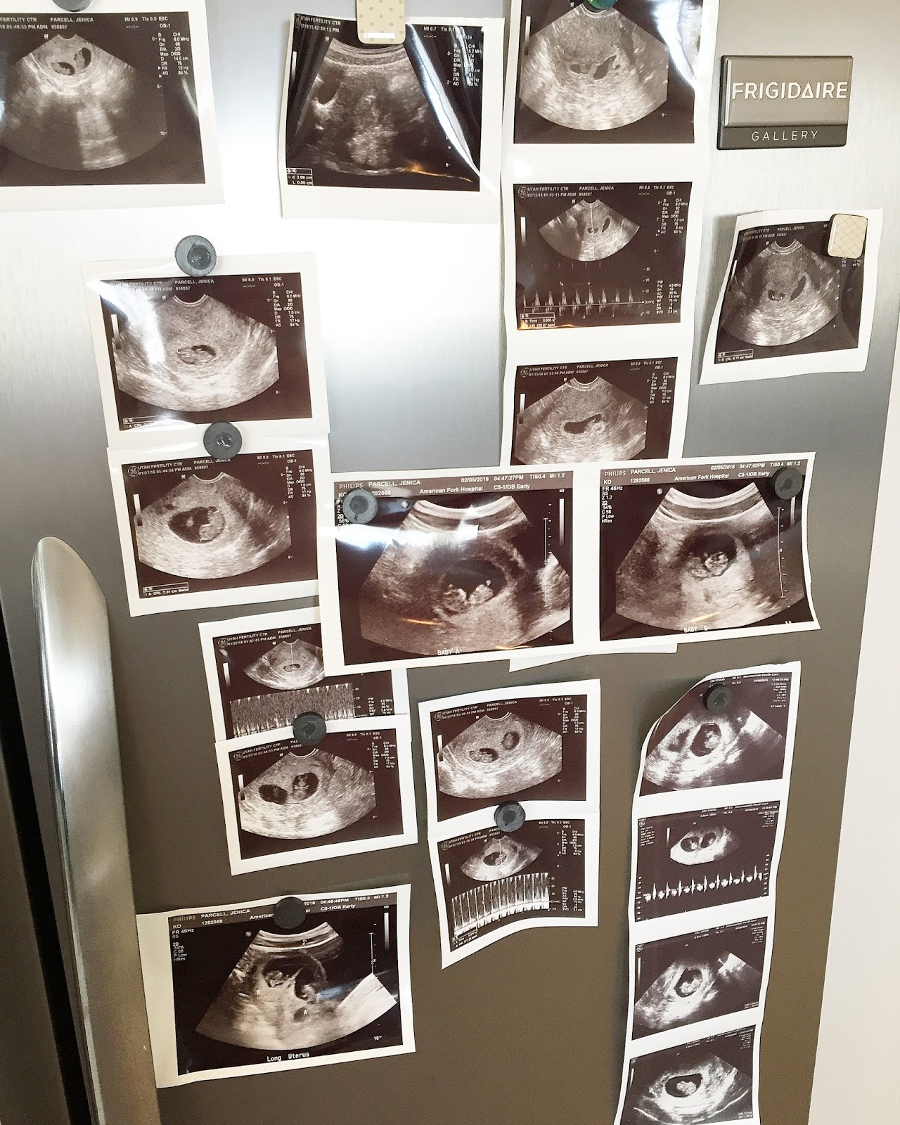 10 Week Pregnant with Twins! A Slice of Style