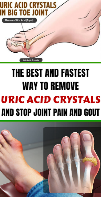 The Best And Fastest Way To Remove Uric Acid Crystals And Stop Joint