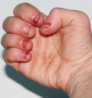 Uñas comidas
