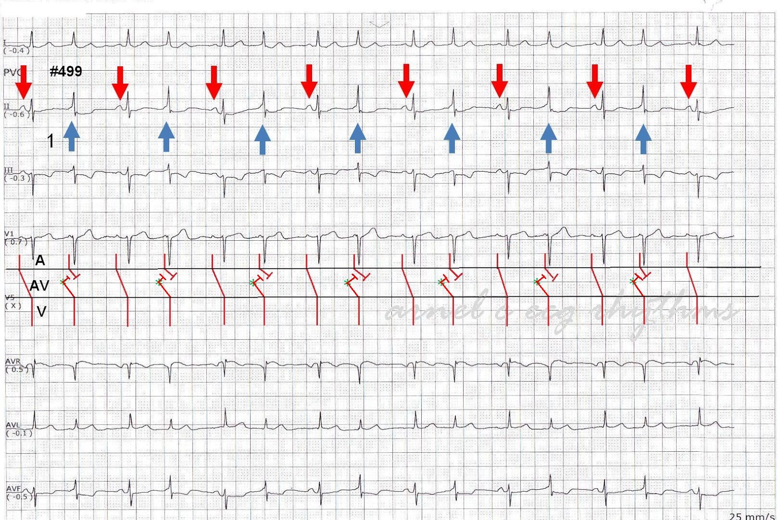 ECG Rhythms Intermittent preexcitation, QRS alternans or intermittent