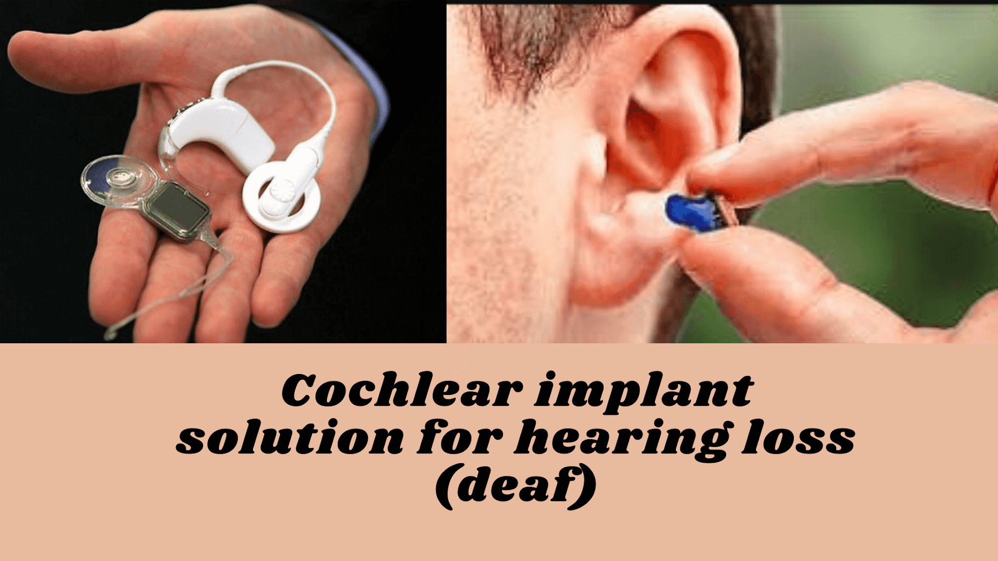 Do Cochlear Implants Help Tinnitus 2025