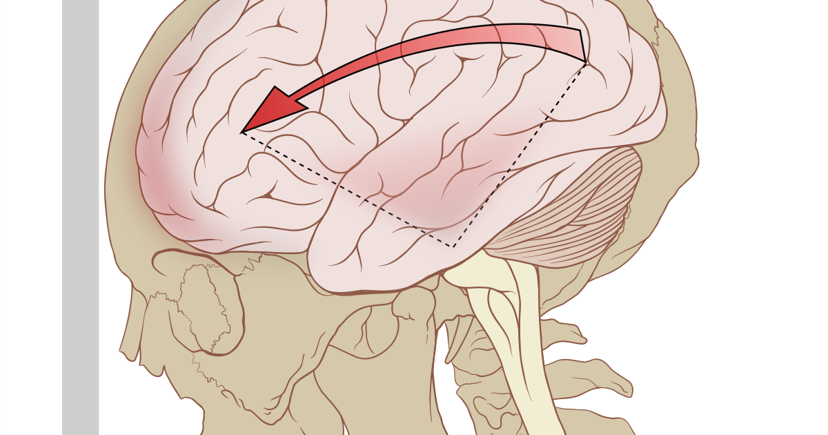 Мозг через рот. Противоудар головного мозга. Контузия головного мозга. Импрессионная травма головного мозга.