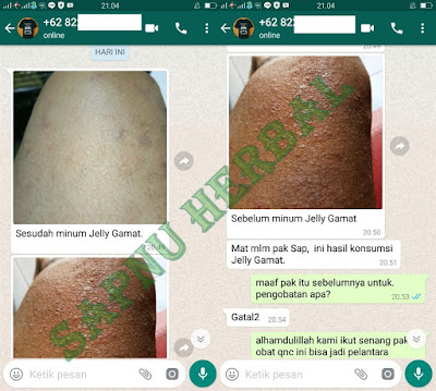 Cara Mengobati Biduran Sampai Tuntas Agar Tidak kambuh Lagi Cara Mengobati Biduran Sampai Tuntas Agar Tidak kambuh Lagi