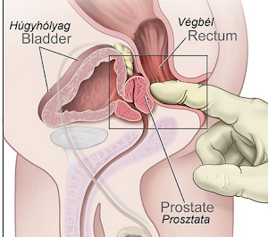 prostatitis és húgyhólyag