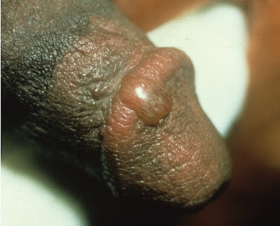 Fixed drug eruption presenting as a bulla of the glans penis