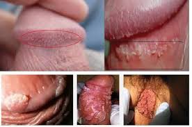 Paket Obat Kutil Kelamin De Nature Paket Obat Kutil Kelamin De Nature