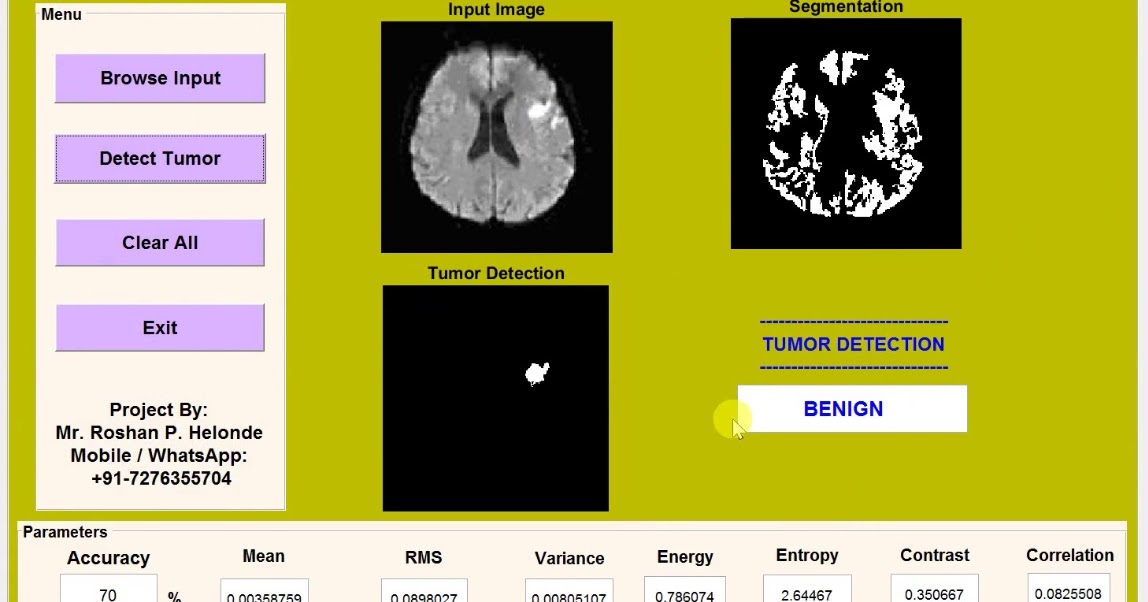 Brain Tumor Detection and Classification Matlab Project Source Code