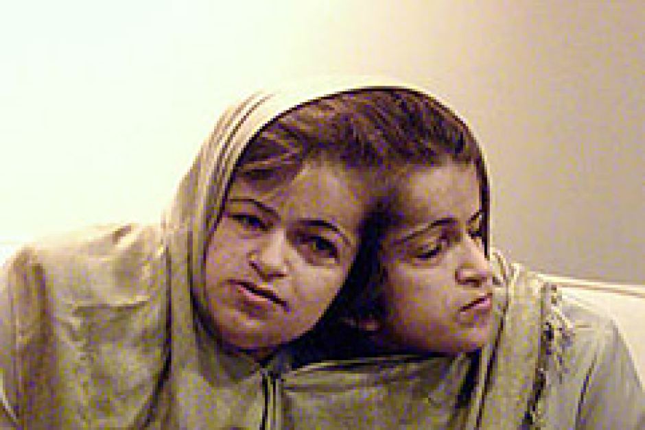 Сестры биджани. Сёстры биджани. Сиамские сёстры биджани. Сёстры биджани операция.