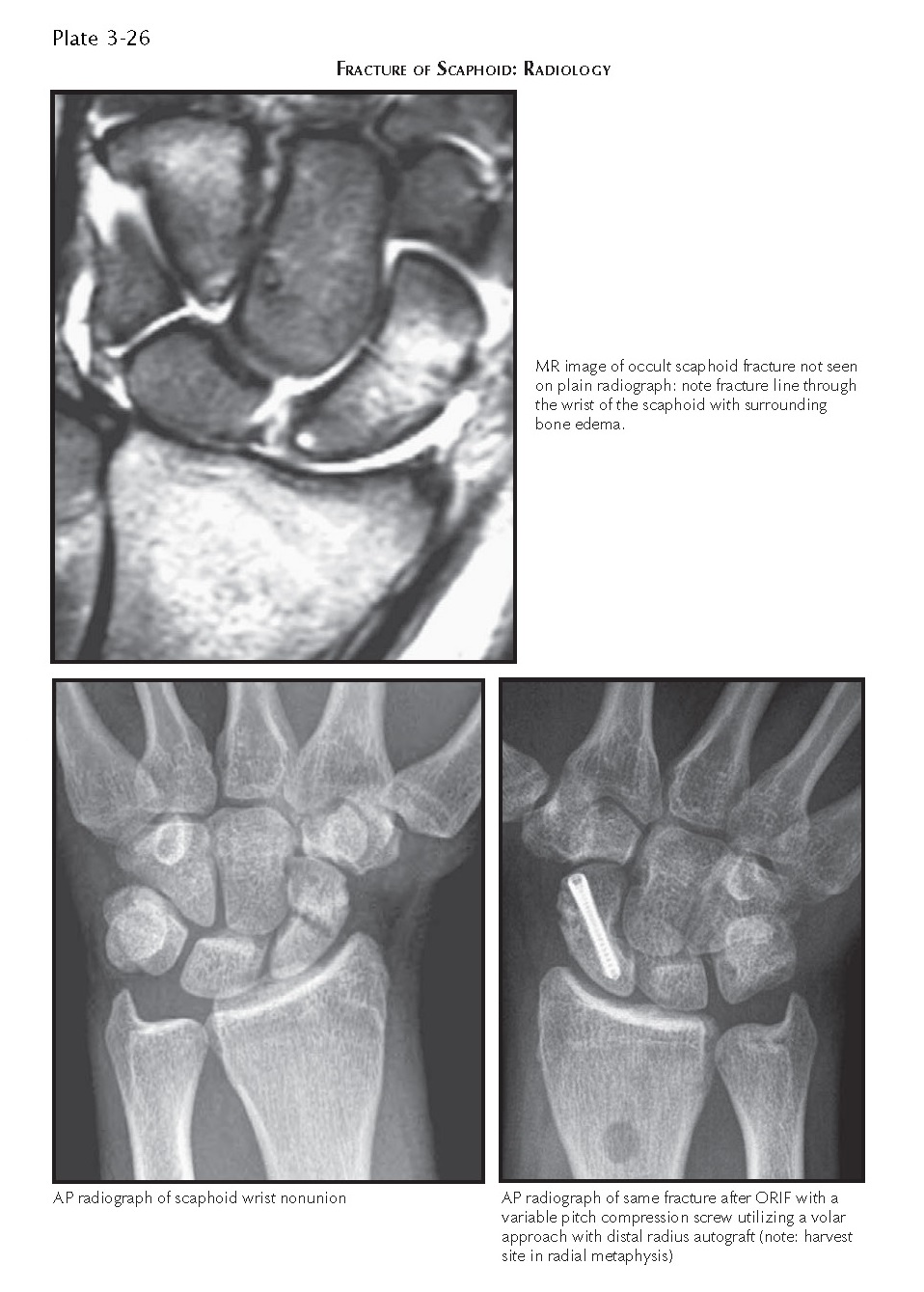 FRACTURE OF SCAPHOID pediagenosis