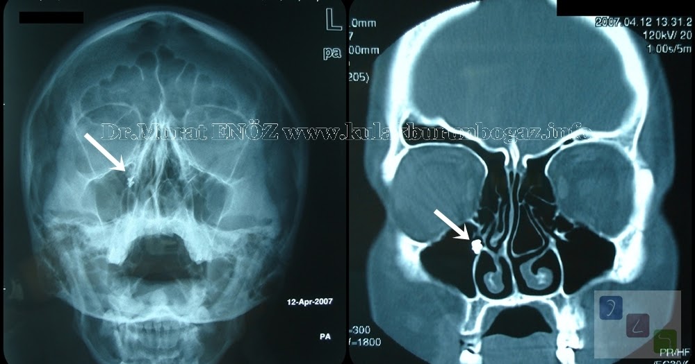 Tooth Filling Material (Amalgam) in the Maxillary Sinus