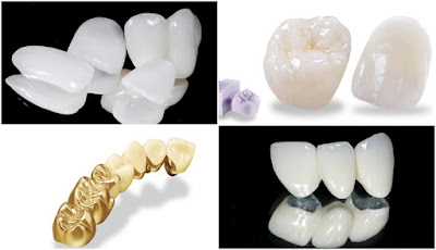 Các loại răng bọc sứ được sử dụng phổ biến