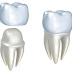 Răng sứ cercon là gì ?