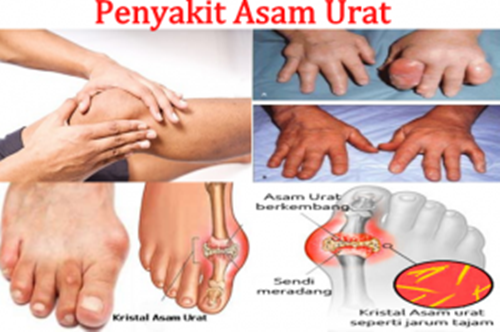 Mengobati Asam Urat Paling Ampuh, Cara Membuat Obat Asam Urat Dari Daun Binahong, Obat Sakit Asam Urat Herbal, Gejala Umum Asam Urat, Asam Urat Ga Boleh Diurut, Obat Alami Asam Urat Di Lutut, Asam Urat Kolesterol Dan Gula, Hasil Cek Asam Urat Normal, Cara Pengobatan Asam Urat Dengan Jeruk Nipis, Ciri Asam Urat Dan Kolesterol Tinggi, Asam Urat Dan Hiperurisemia, Lauk Pauk Untuk Asam Urat Dan Kolesterol, Obat Asam Urat Tradisional Dan Alami, Obat Asam Urat Herbal Untuk Ibu Hamil, Bagaimana Mengatasi Asam Urat Dan Kolesterol, Cek Asam Urat Puasa, Mengobati Asam Urat Dengan Buah, Mengatasi Asam Urat Secara Tradisional, Apa Gejala Asam Urat Dan Pengobatannya, Asam Urat Dan Cara Menyembuhkan, Obat Tradisional Utk Penyakit Asam Urat, Obat Asam Urat Dan Rematik Yang Alami, Obat Untuk Asam Urat Yg Bagus, Asam Urat Penyebab Dan Gejalanya, Asam Urat Dan Gula Darah Tinggi, Obat Asam Urat Ampuh Di Apotik, Cara Mengatasi Asam Urat Kolesterol, Faktor Genetik Asam Urat, Mengatasi Asam Urat Di Kaki, Obat Asam Urat Jahe 