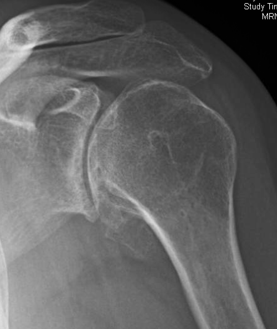 Shoulder Arthritis / Rotator Cuff Tears / Shoulder Pain Technological