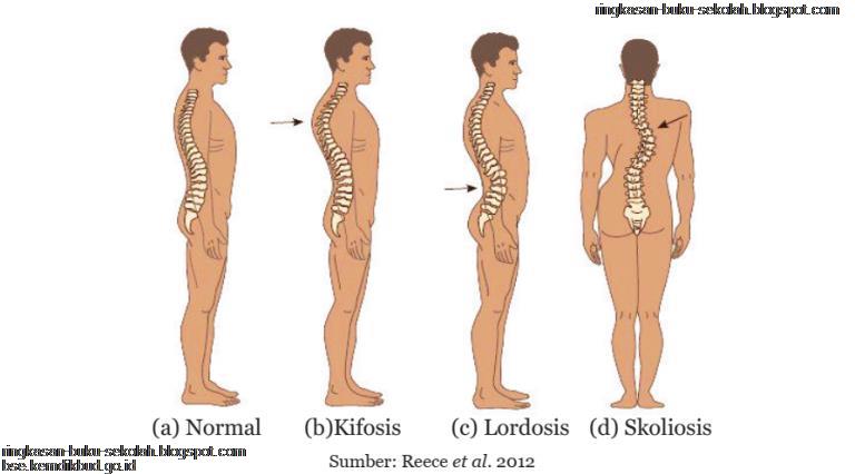 Tiga kelainan tulang belakang yang umum terjadi adalah lordosis, kifosis, d...