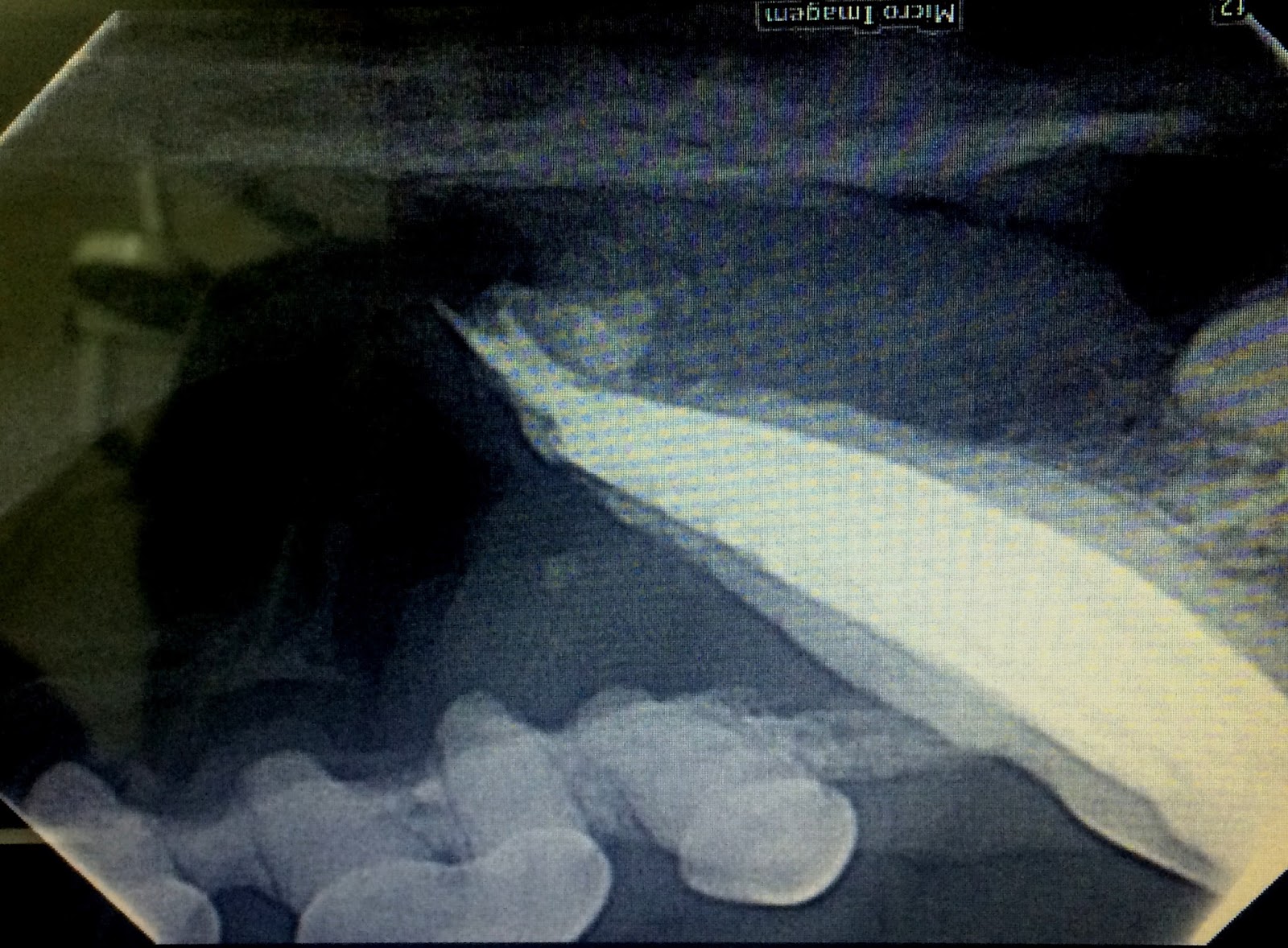 Fístula intraoral com reabsorção radicular pós tratamento endodôntico