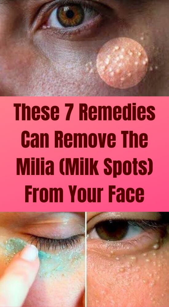 These 7 Remedies Can Remove The Milia (Milk Spots) From Your Face Healthy Group