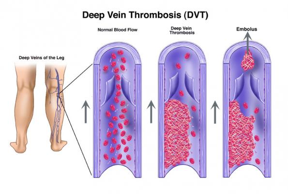Deep Vein Thrombosis Ayurvedic Treatment