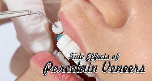 Side Effects of Porcelain Veneers