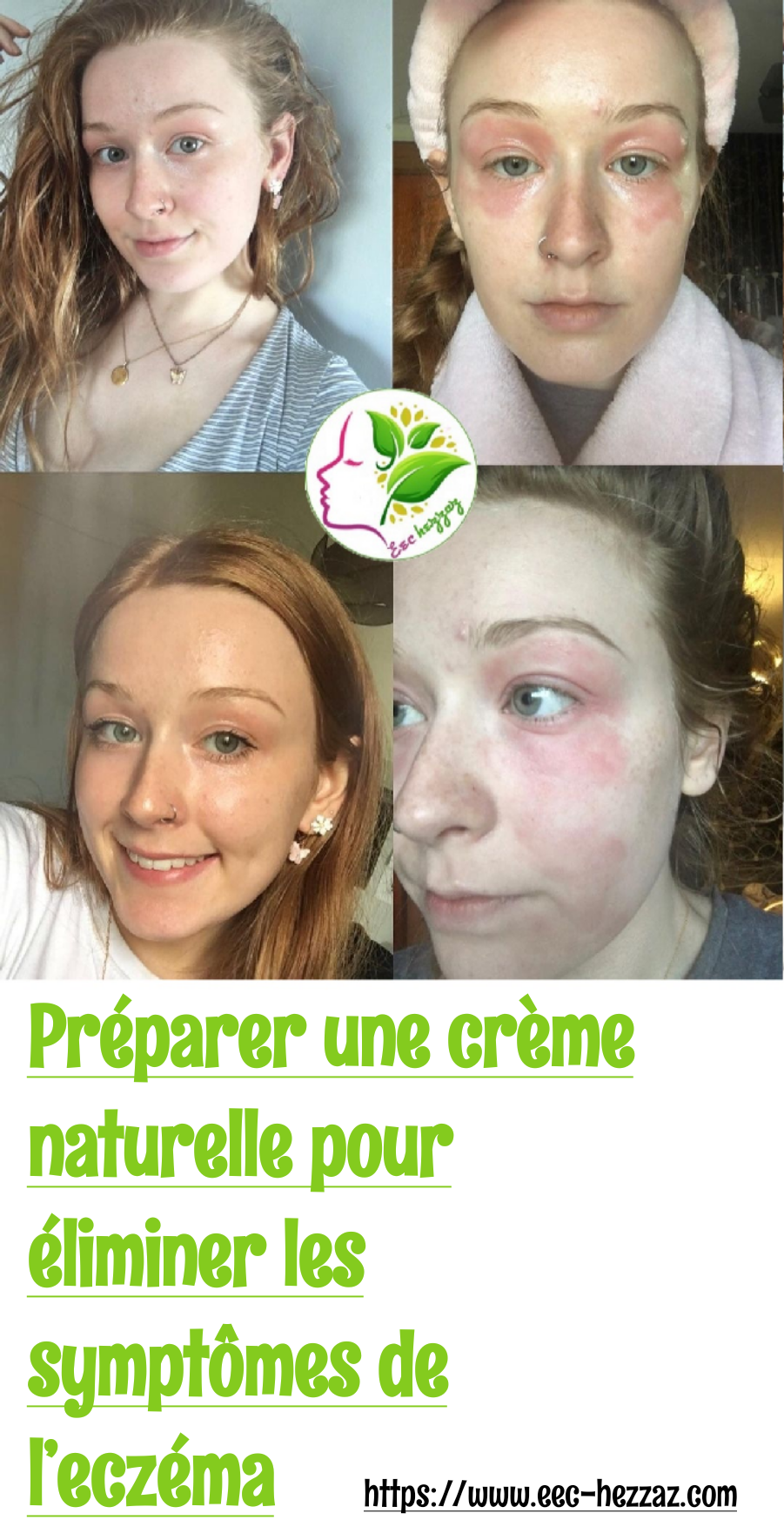 Préparer une crème naturelle pour éliminer les symptômes de l’eczéma