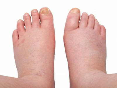 Phù thận có những đặc điểm gì ? Tại sao phù thận lại đột ngột ?