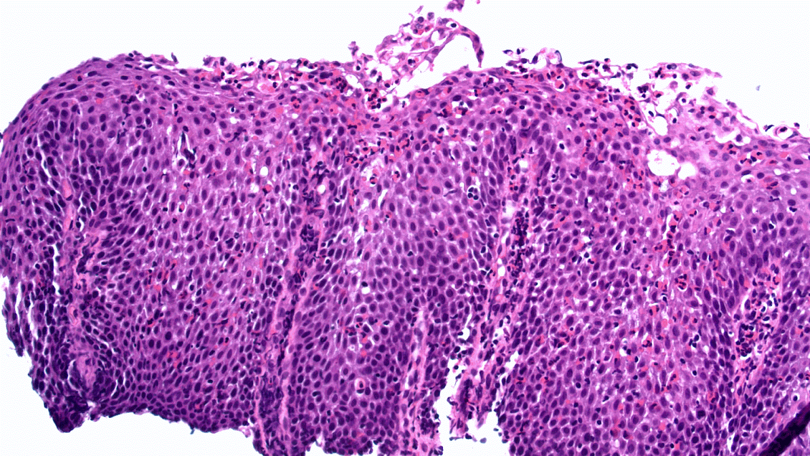 Esophagitis Ulcerative Esophagitis Ulcer Choices