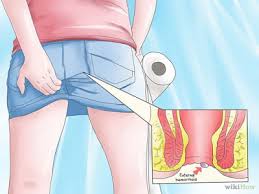 Foto Obat Wasir Anak
