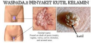 Obat Kutil Kelamin ampuh rekomendasi dokter di apotik