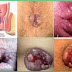 Selain Ambeven? Obat Manjur Ambeyen Apa? thumbnail