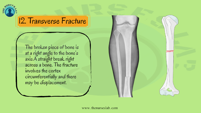 Types of Bone Fracture