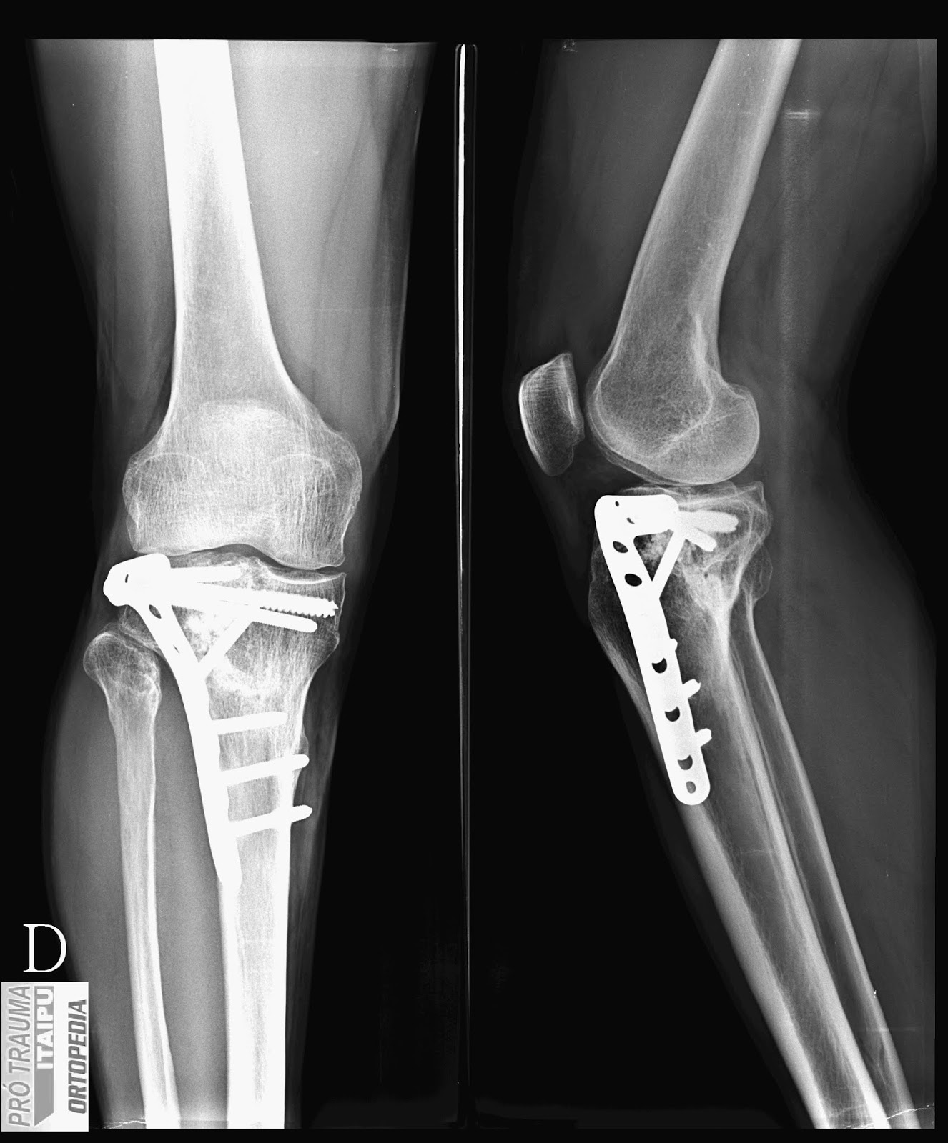 Tibiakopffraktur - TIBIAL PLATEU FRACTURE - АДНАЎЛЕННЕ пералому PLATO ...