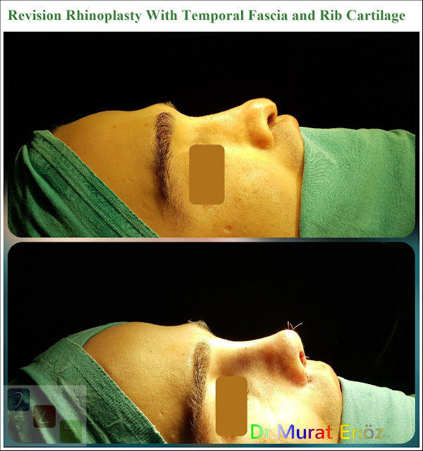 Revision Rhinoplasty With Temporal Fascia and Rib Cartilage Istanbul Turkey