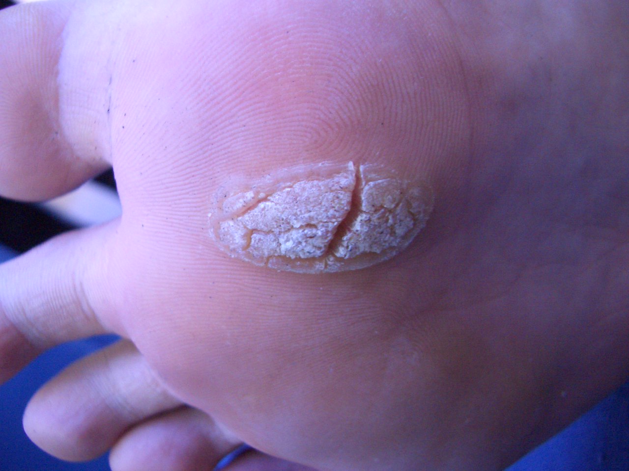 Treating heel pain fast, best wart remover for feet