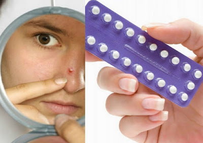 Does Birth Control Help Acne ?