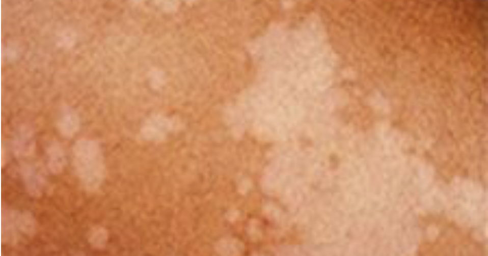 11 Macam-macam Penyakit Kulit Yang Disebabkan Oleh Jamur | Portal