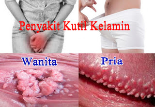 Obat Kutil Kelamin herbal yg ampuh paten