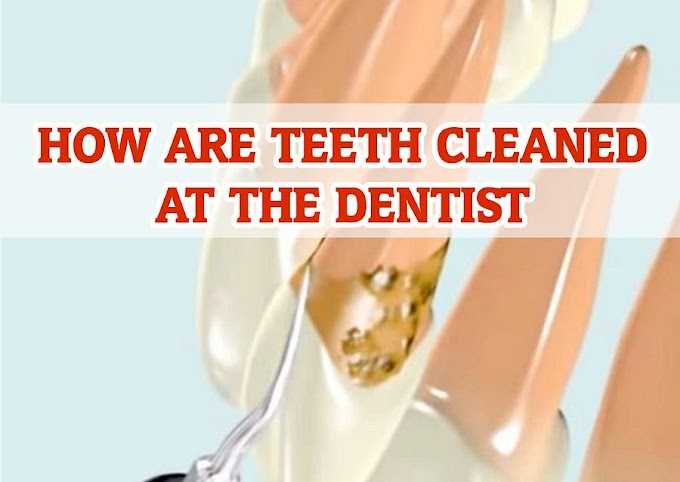 How are Teeth Cleaned at the dentist - Dr. Hideaki Hirooka